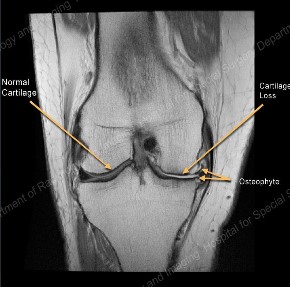 Οστεοπόρωση - αρθροπλαστική γόνατος και ισχίου